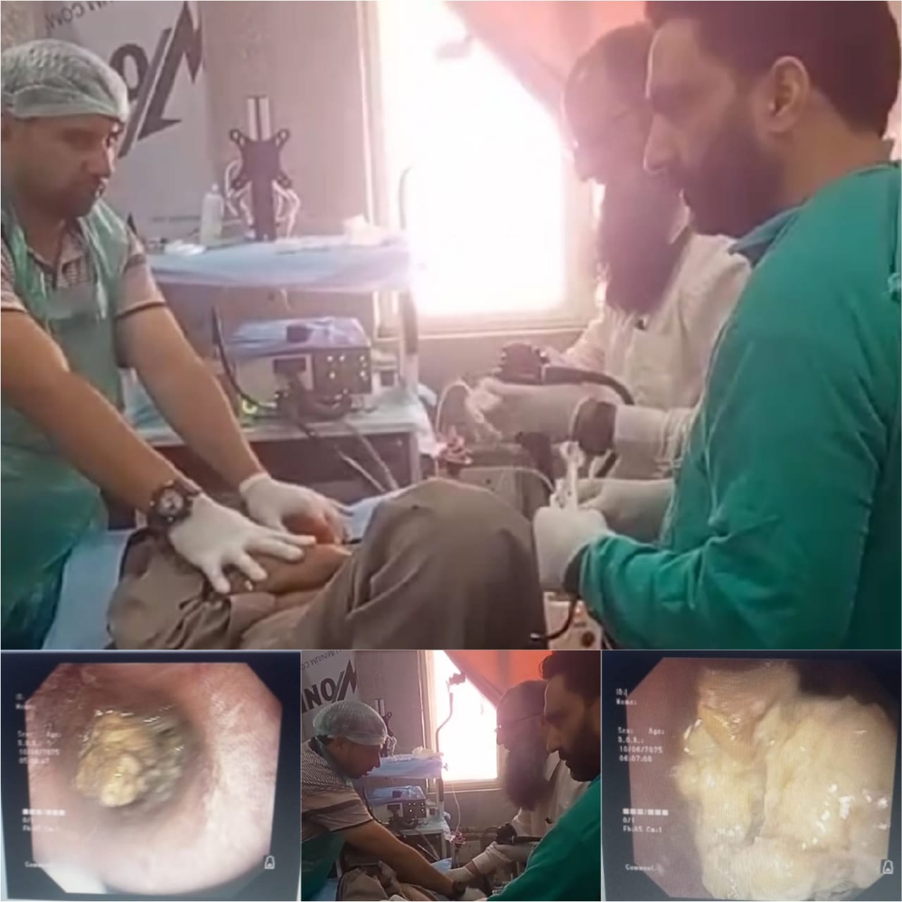 Large meat bolus  stuck in oesophagus successfully removed at District Hospital Kulgam
